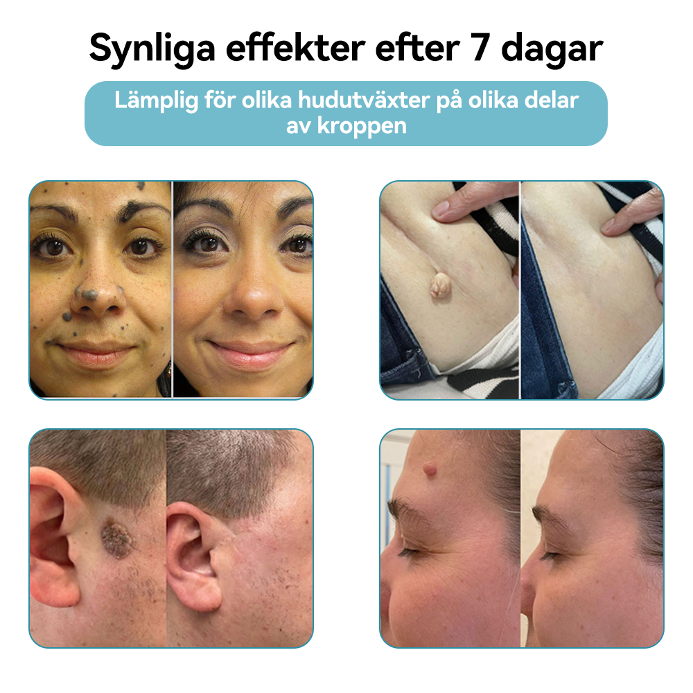Bikenda®🍁💖 laserpenna (med CO₂-laserteknik – effektiv för att ta bort födelsemärken, vårtor, hudflikar, pigmentfläckar och andra hudproblem)