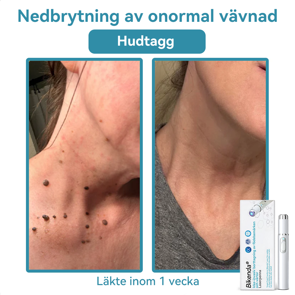 Bikenda®🍁💖 laserpenna (med CO₂-laserteknik – effektiv för att ta bort födelsemärken, vårtor, hudflikar, pigmentfläckar och andra hudproblem)