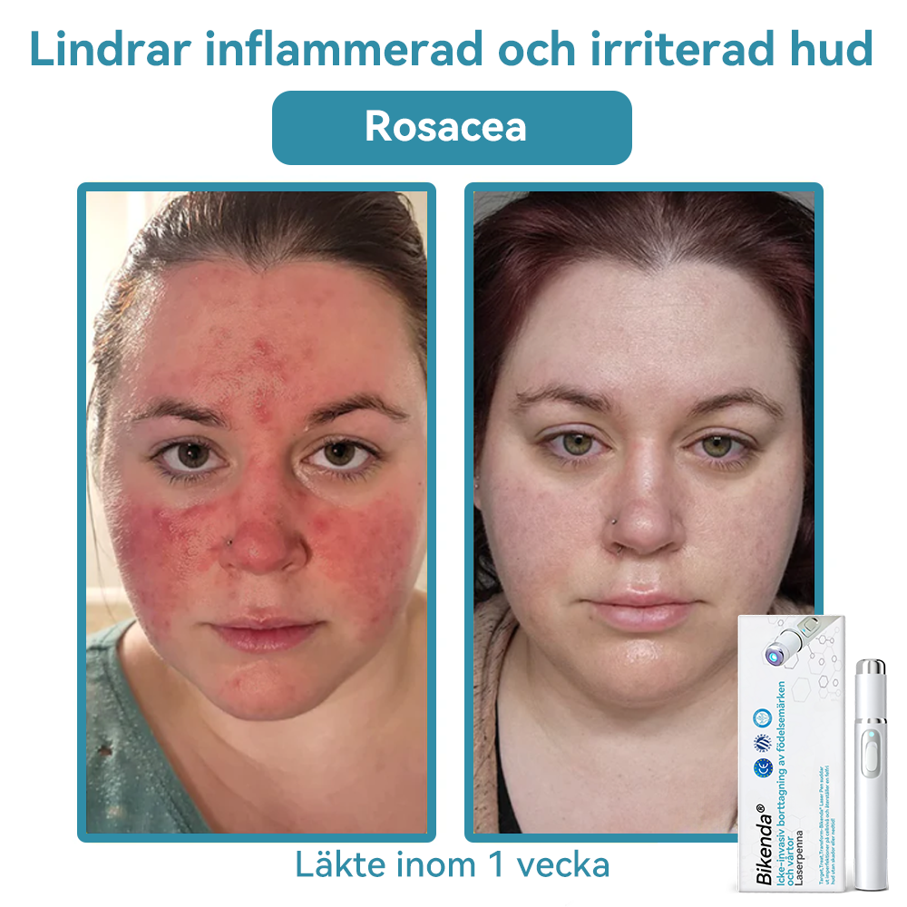 Bikenda®🍁💖 laserpenna (med CO₂-laserteknik – effektiv för att ta bort födelsemärken, vårtor, hudflikar, pigmentfläckar och andra hudproblem)